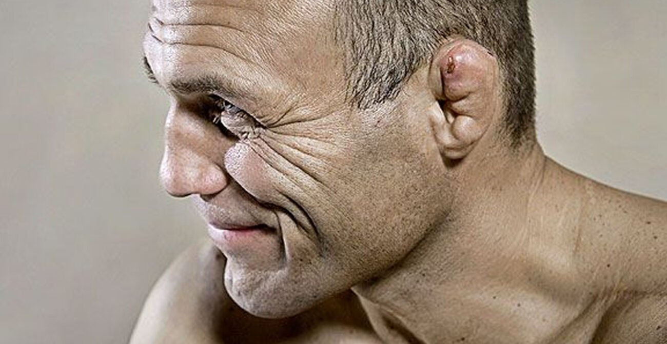 Is Cauliflower Ear Dangerous? A Simple Guide for Kids and Parents